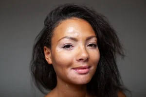 African woman with vitiligo on face smiling